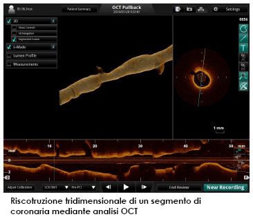 Riscotruzione tridimensionale di un segmento di coronaria mediante analisi OCT